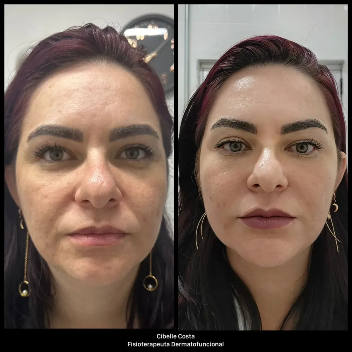 Comparação antes e depois de paciente da REALCE, vista frontal do rosto: à esquerda, antes; à direita, depois — caso facial 01