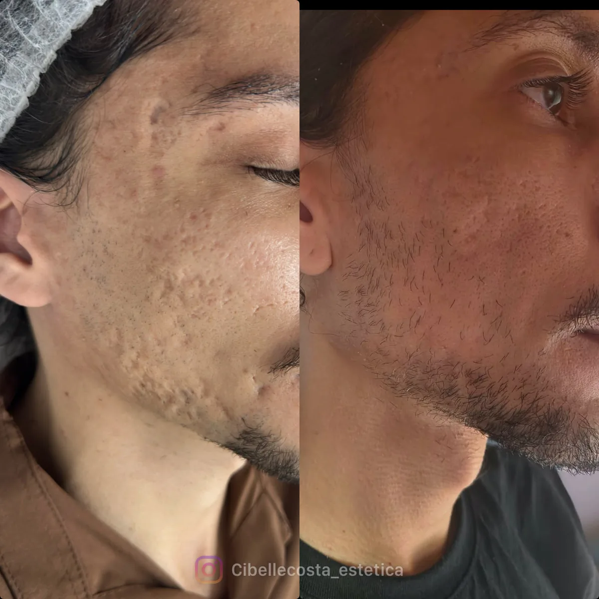 Comparação antes e depois de paciente da REALCE, close-up da lateral do rosto: à esquerda, antes; à direita, depois — caso facial 02