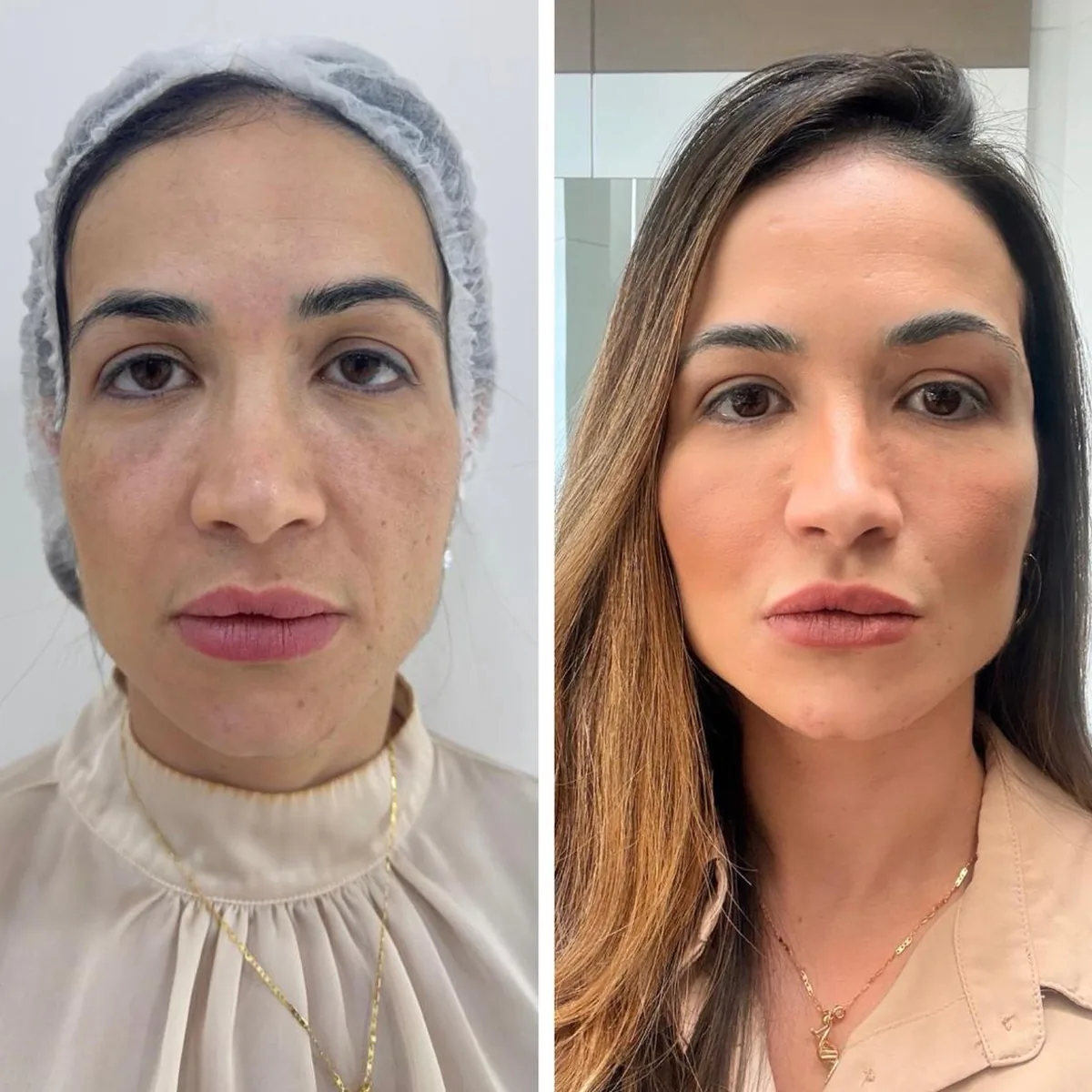 Comparação antes e depois de paciente da REALCE, vista frontal do rosto: à esquerda, antes; à direita, depois — caso facial 03