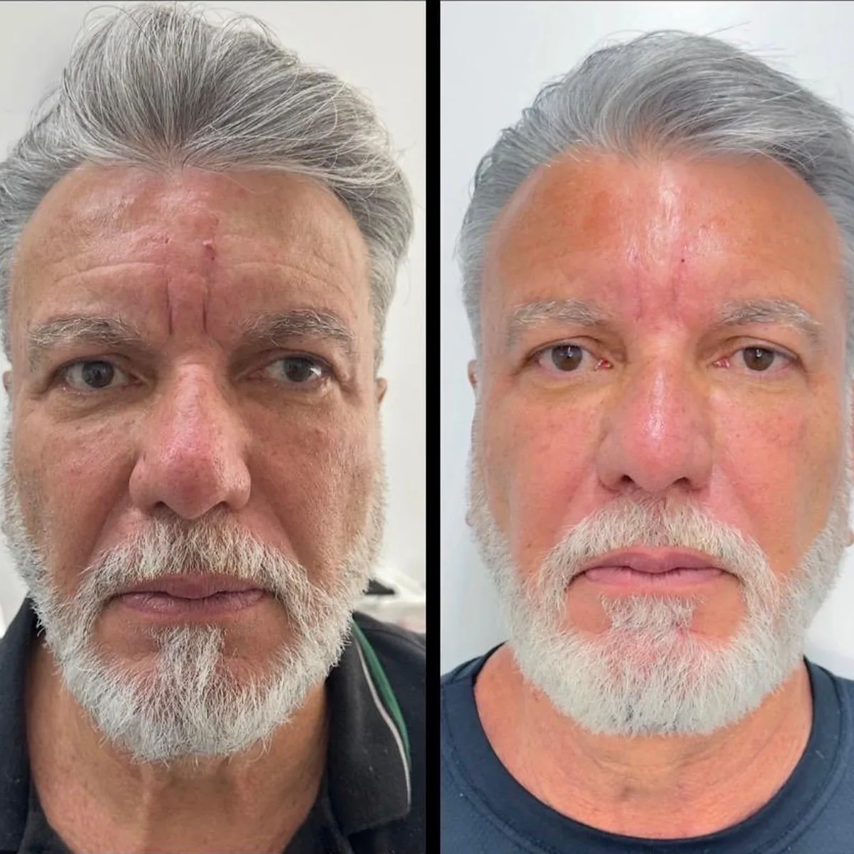Comparação antes e depois de paciente da REALCE, vista frontal do rosto: à esquerda, antes; à direita, depois — caso facial 04